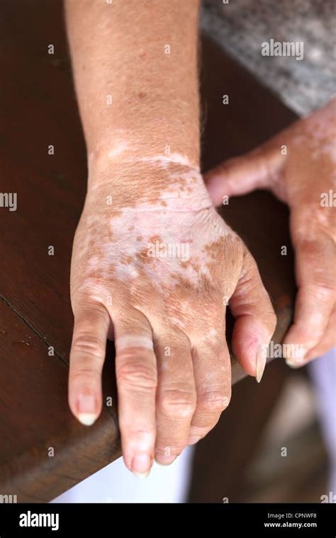 vitiligo fotos|Le vitiligo Banque de photographies et d’images à。